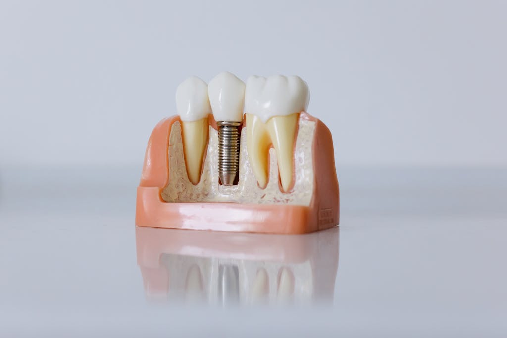 Implante dentário São Paulo