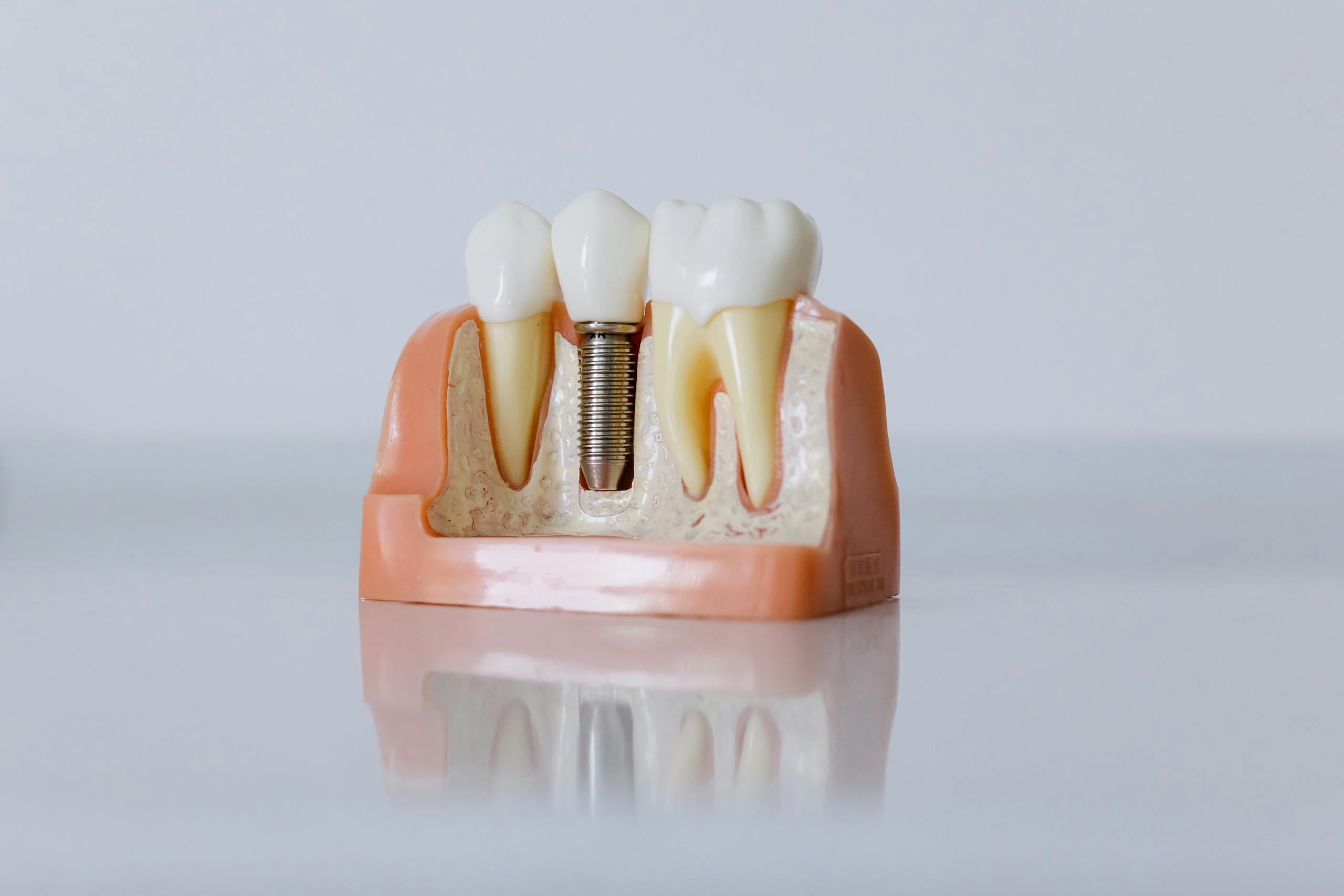 Implante dentário São Paulo